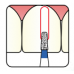 Osung Crown Anterior/ Depth Orientation Flat Round (Taper) FG Shank 584-14M1 Medium Grit Diamond Bur 5/PK